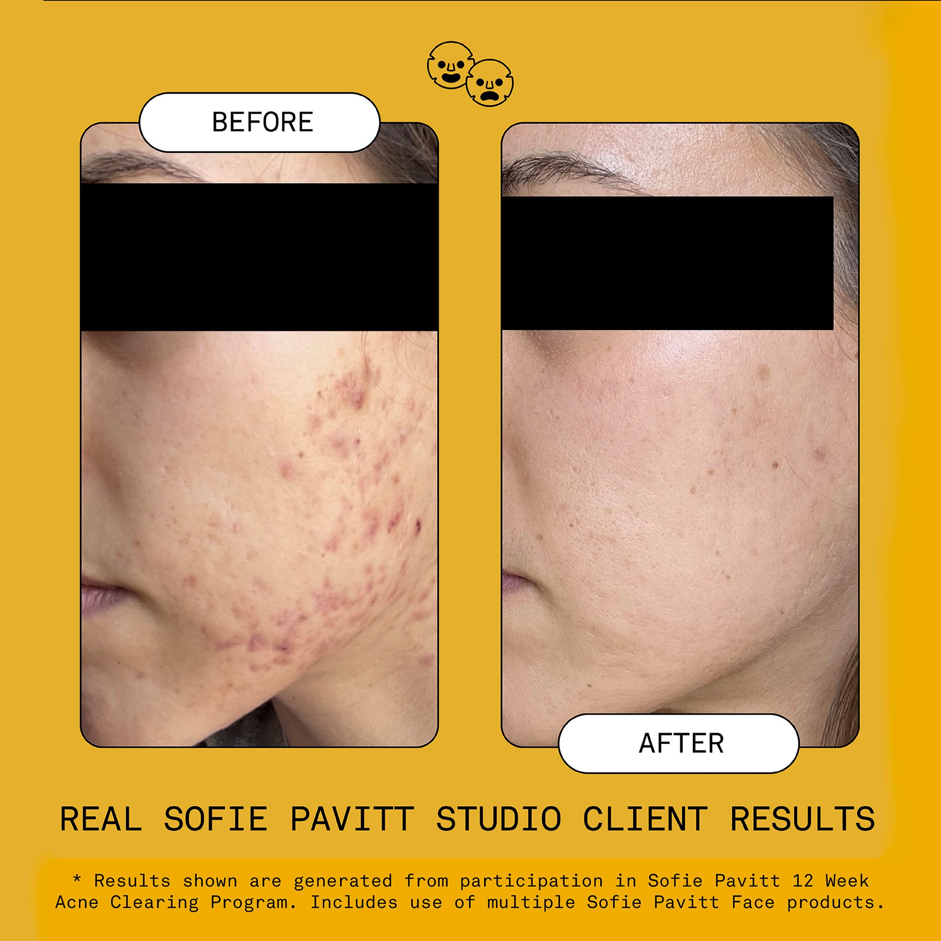 Reset Benzoyl Peroxide Acne Treatment Mask