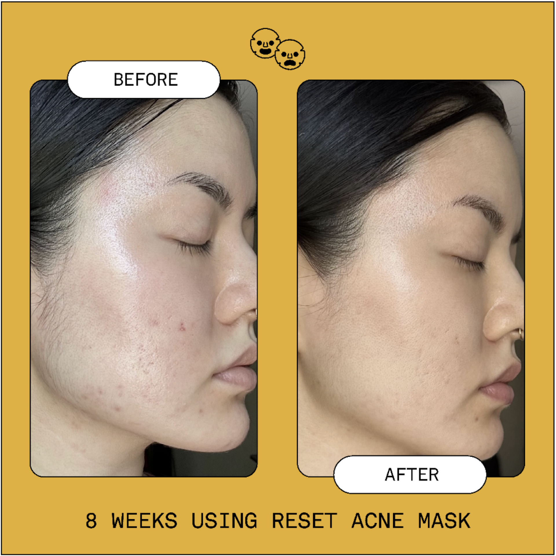 Reset Benzoyl Peroxide Acne Treatment Mask