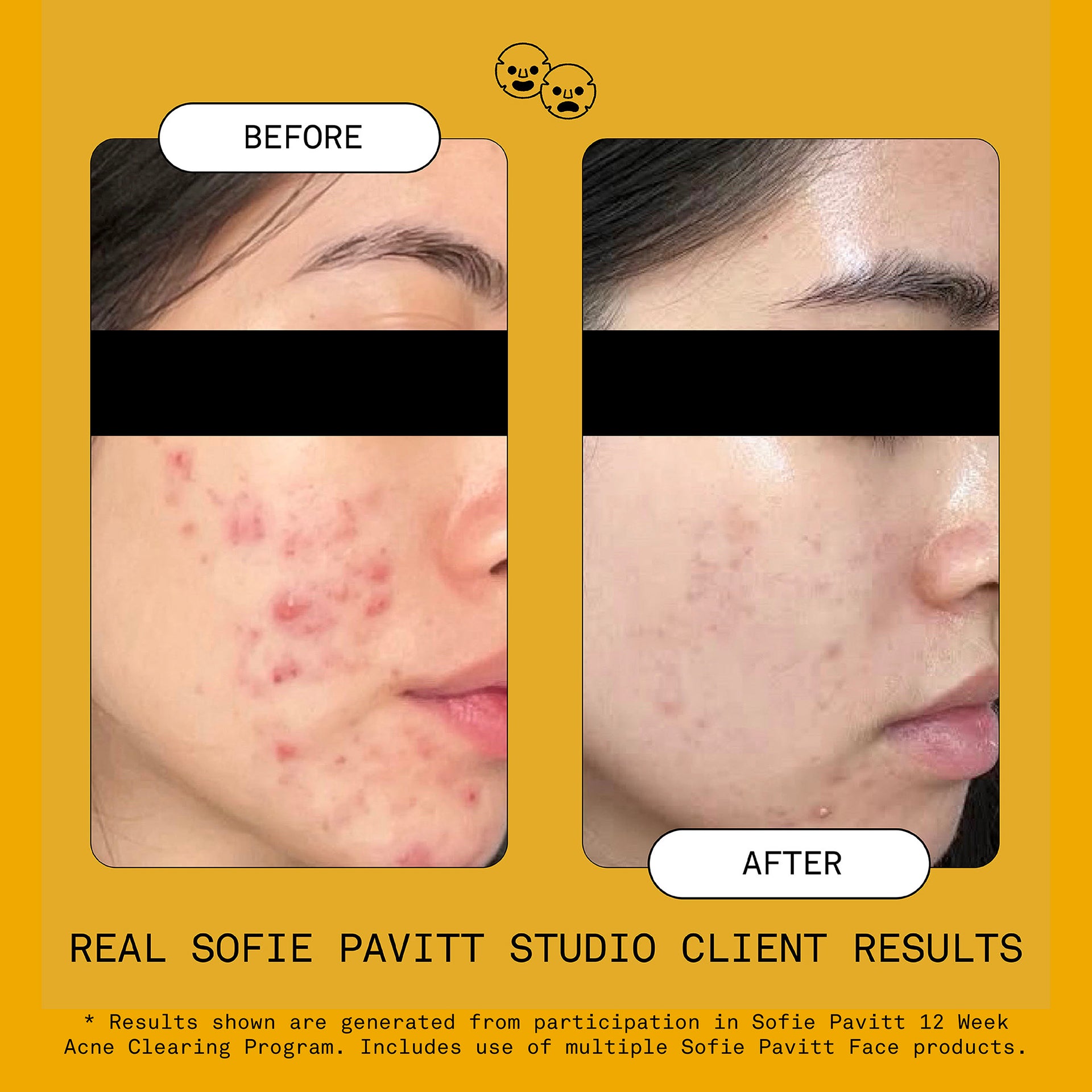 Reset Benzoyl Peroxide Acne Treatment Mask