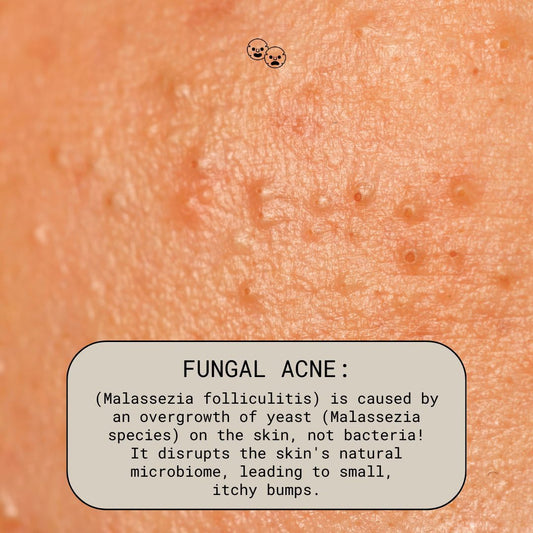 What Is Fungal Acne?