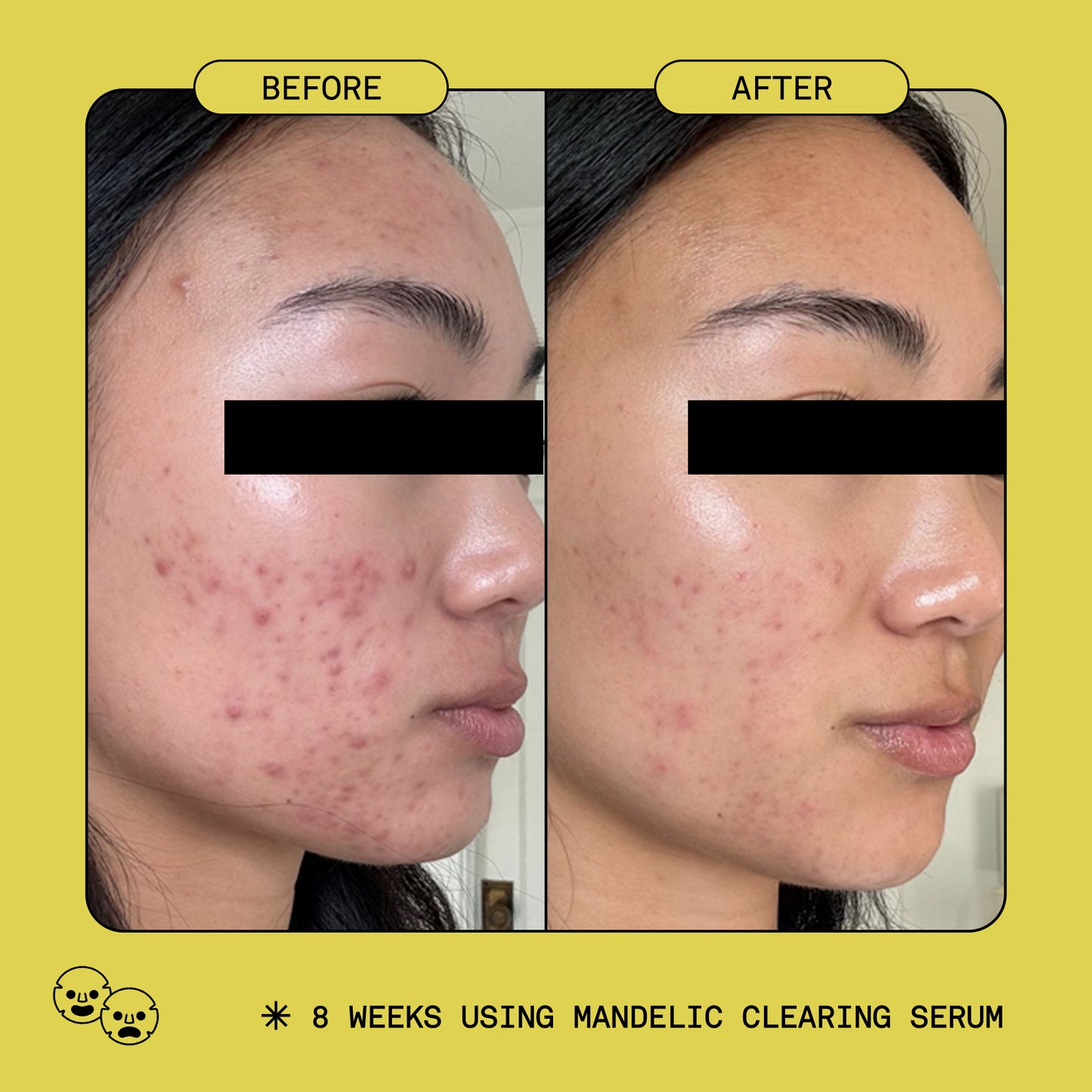 Acne Essentials