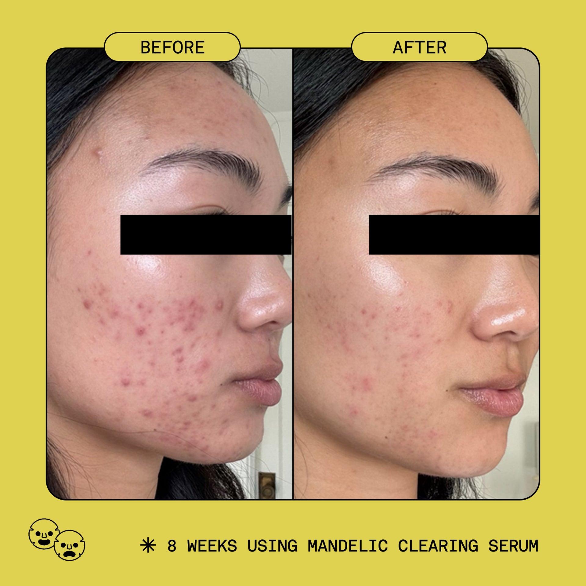 Acne Essentials