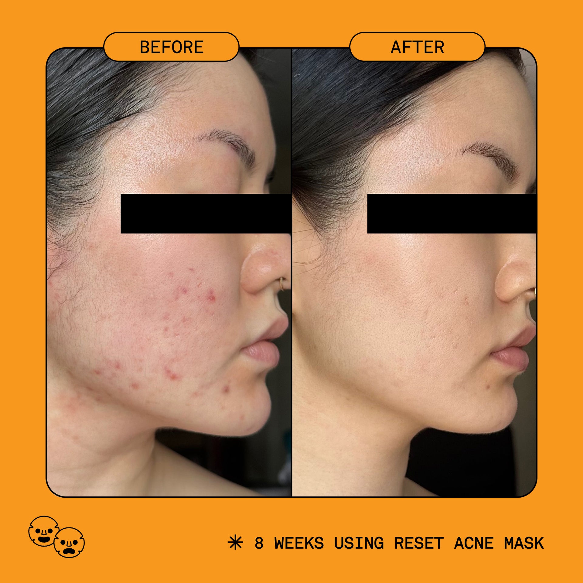 Reset 5% Benzoyl Peroxide Acne Treatment