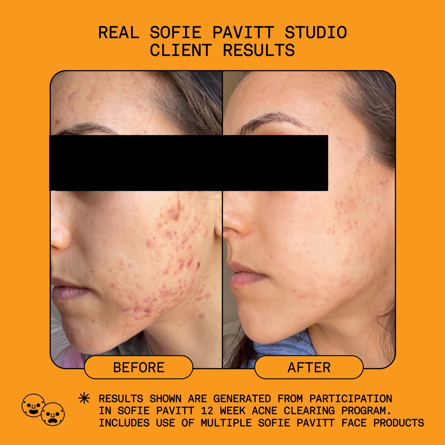 Reset 5% Benzoyl Peroxide Acne Treatment
