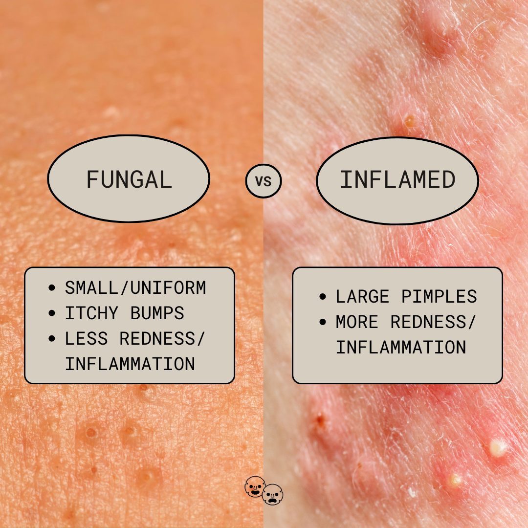 Fungal Acne: Effective Solutions for Clear Skin